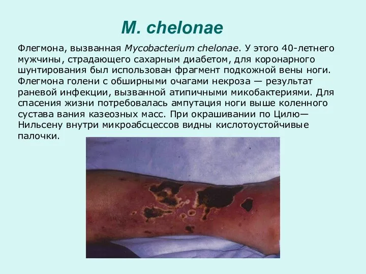 M. chelonae Флегмона, вызванная Mycobacterium chelonae. У этого 40-летнего мужчины, страдающего