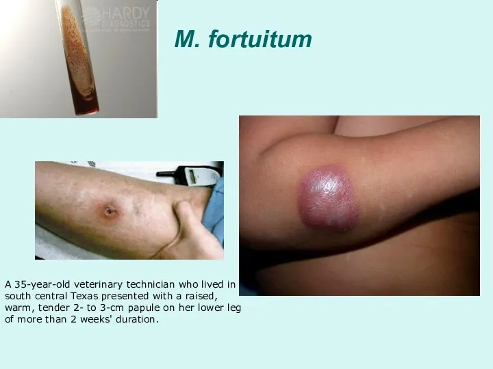 M. fortuitum A 35-year-old veterinary technician who lived in south central