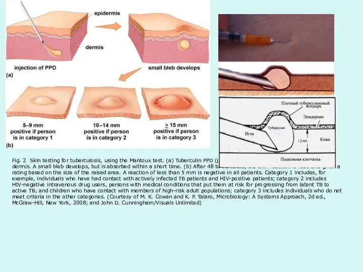 Fig. 2 Skin testing for tuberculosis, using the Mantoux test. (a)