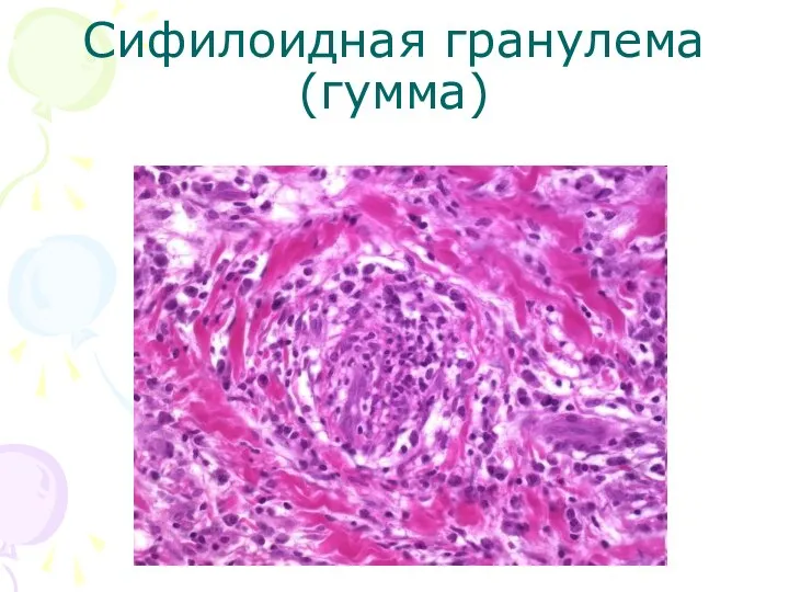 Сифилоидная гранулема (гумма)