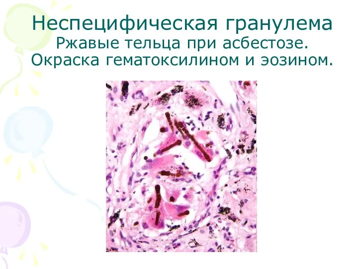 Неспецифическая гранулема Ржавые тельца при асбестозе. Окраска гематоксилином и эозином.