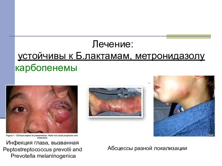 Инфекция глаза, вызванная Peptostreptococcus prevotii and Prevotella melaninogenica Лечение: устойчивы к