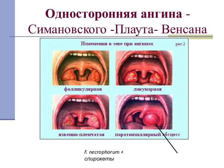 Односторонняя ангина - Симановского -Плаута- Венсана F. necrophorum + спирохеты