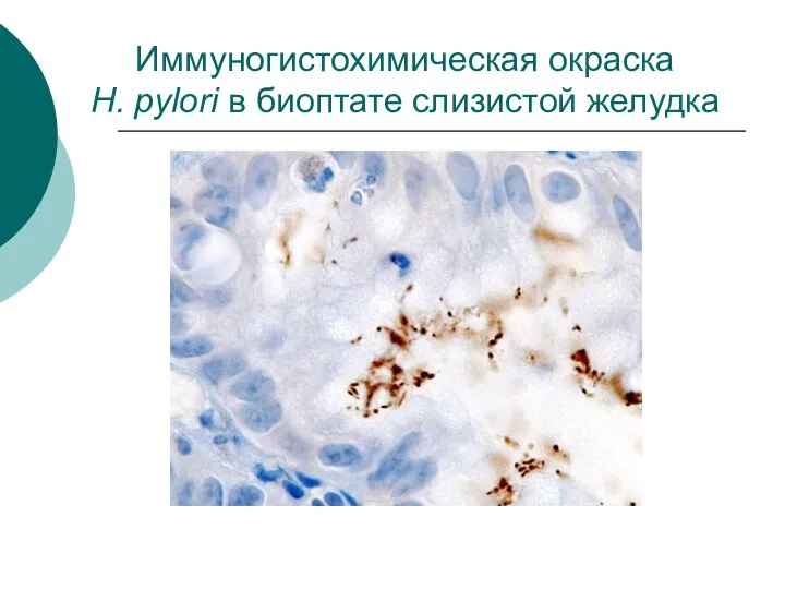 Иммуногистохимическая окраска H. pylori в биоптате слизистой желудка