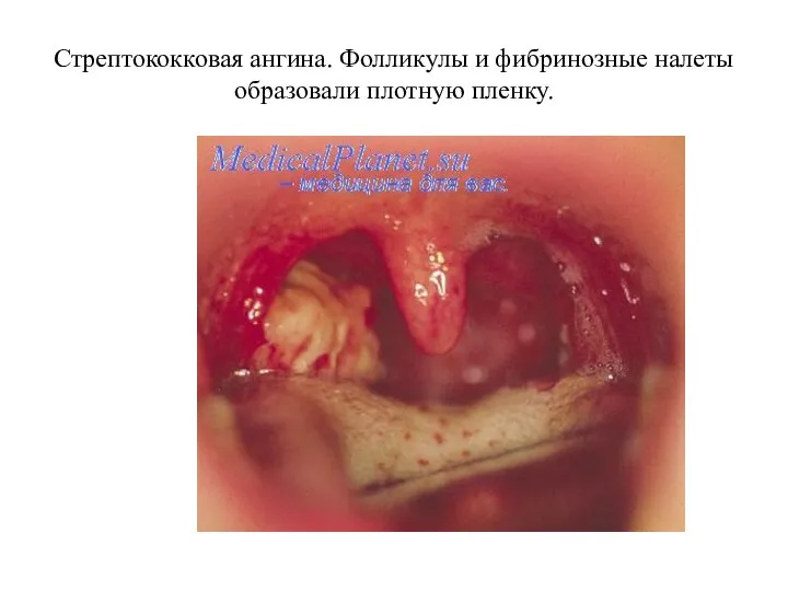 Стрептококковая ангина. Фолликулы и фибринозные налеты образовали плотную пленку.