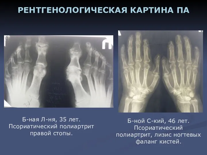 Б-ной С-кий, 46 лет. Псориатический полиартрит, лизис ногтевых фаланг кистей. РЕНТГЕНОЛОГИЧЕСКАЯ