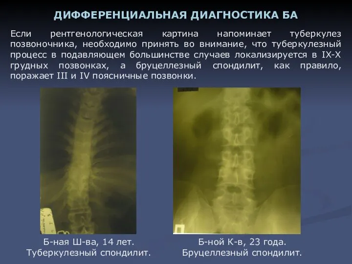Если рентгенологическая картина напоминает туберкулез позвоночника, необходимо принять во внимание, что