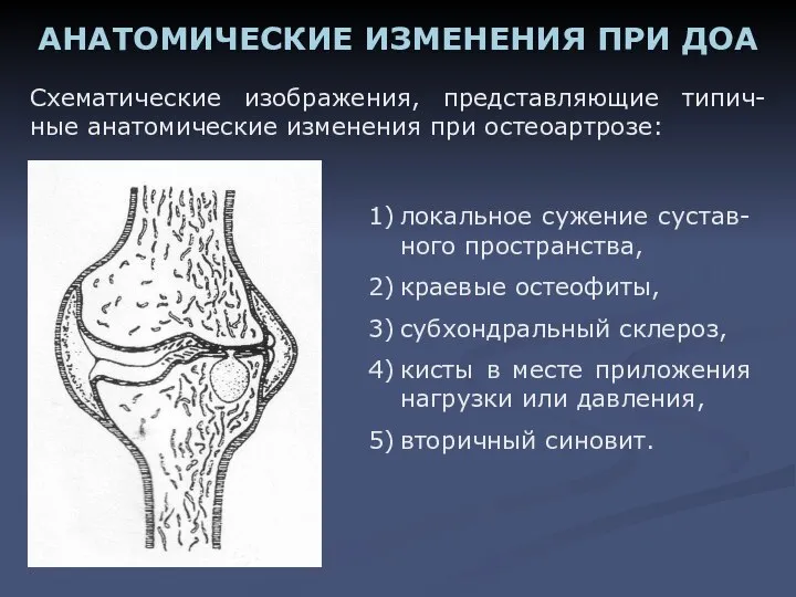 Схематические изображения, представляющие типич-ные анатомические изменения при остеоартрозе: АНАТОМИЧЕСКИЕ ИЗМЕНЕНИЯ ПРИ