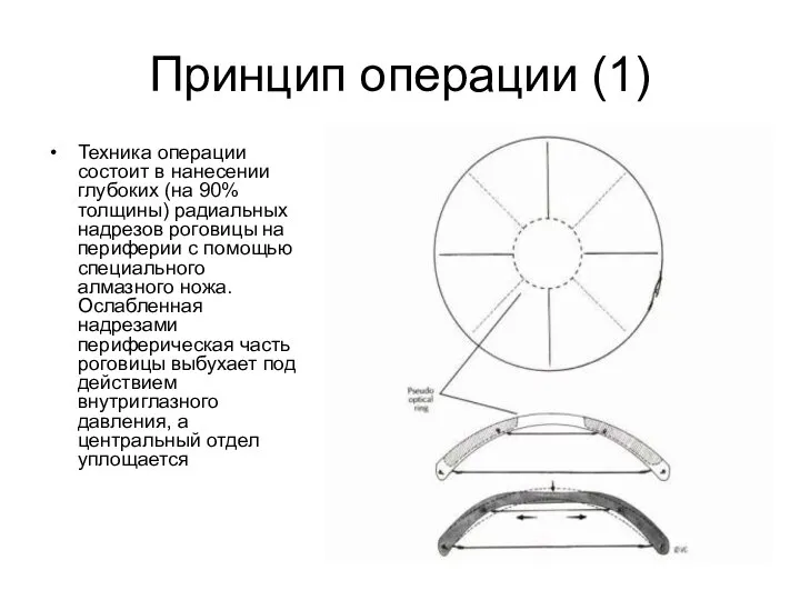 Принцип операции (1) Техника операции состоит в нанесении глубоких (на 90%