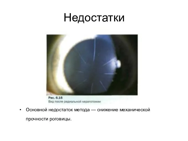 Недостатки Основной недостаток метода — снижение механической прочности роговицы.