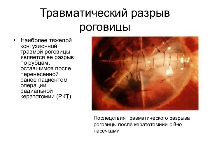 Травматический разрыв роговицы Наиболее тяжелой контузионной травмой роговицы является ее разрыв