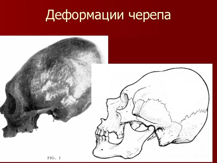 Деформации черепа
