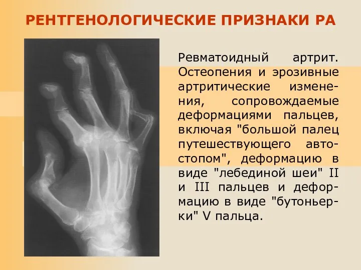 Ревматоидный артрит. Остеопения и эрозивные артритические измене-ния, сопровождаемые деформациями пальцев, включая