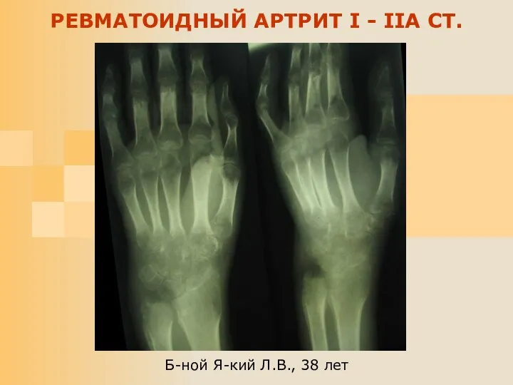 Б-ной Я-кий Л.В., 38 лет РЕВМАТОИДНЫЙ АРТРИТ I - IIA СТ.