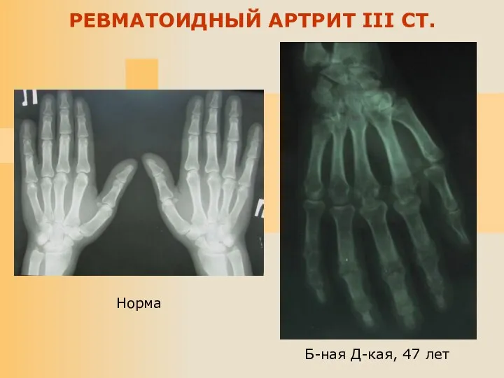 Б-ная Д-кая, 47 лет РЕВМАТОИДНЫЙ АРТРИТ III СТ. Норма