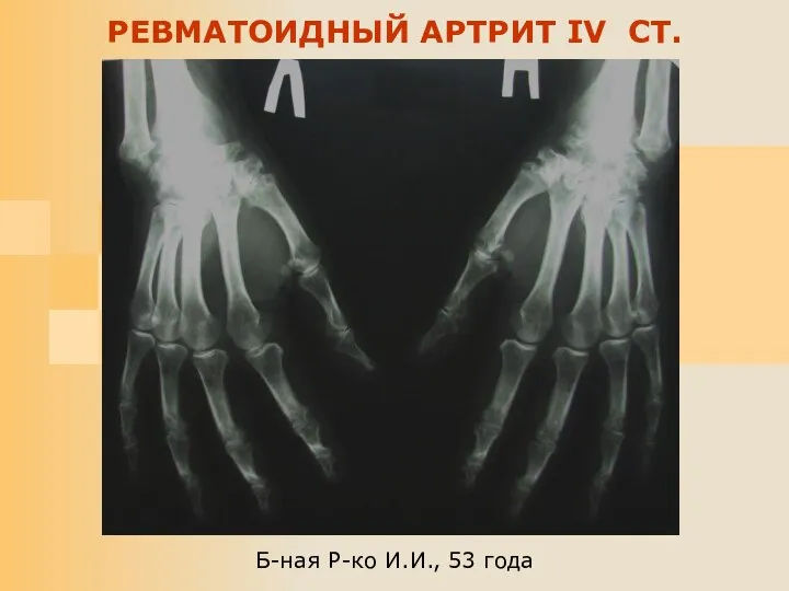 Б-ная Р-ко И.И., 53 года РЕВМАТОИДНЫЙ АРТРИТ IV СТ.