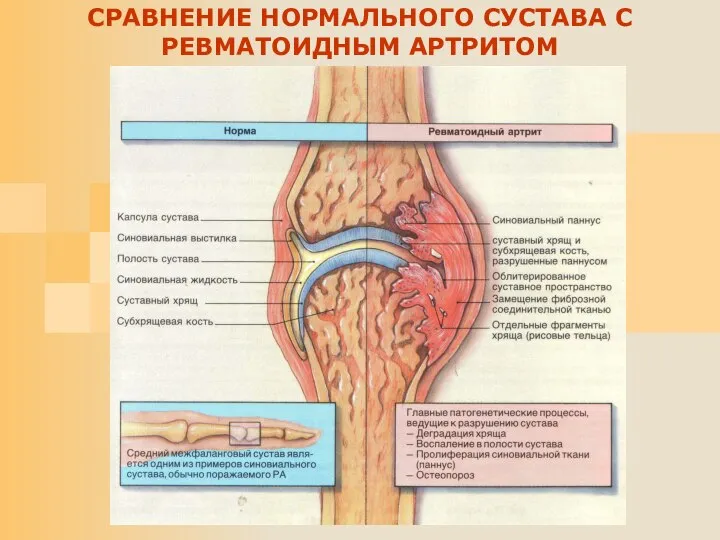 СРАВНЕНИЕ НОРМАЛЬНОГО СУСТАВА С РЕВМАТОИДНЫМ АРТРИТОМ