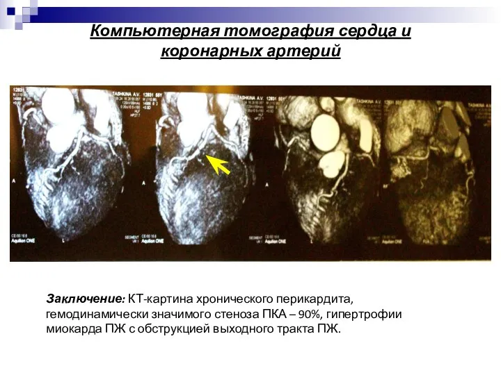 Компьютерная томография сердца и коронарных артерий Заключение: КТ-картина хронического перикардита, гемодинамически