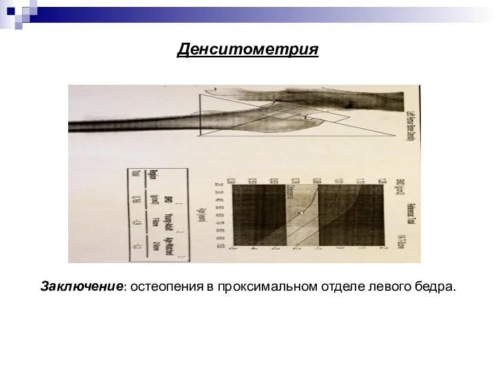 Денситометрия Заключение: остеопения в проксимальном отделе левого бедра.