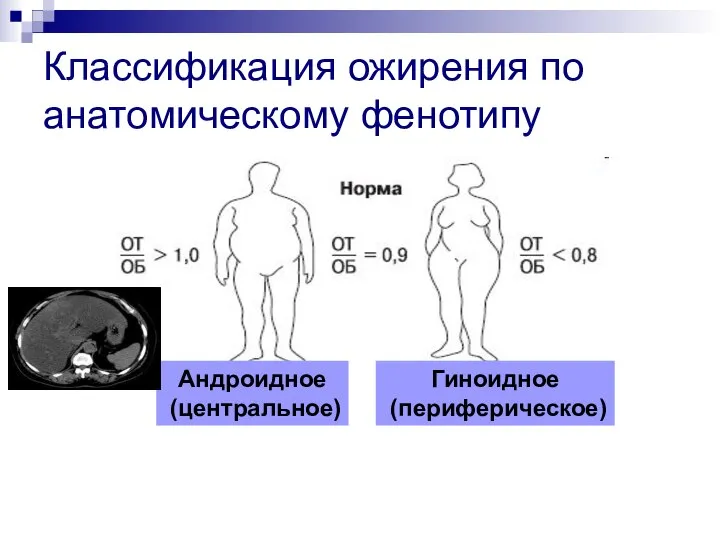 Классификация ожирения по анатомическому фенотипу Андроидное (центральное) Гиноидное (периферическое)