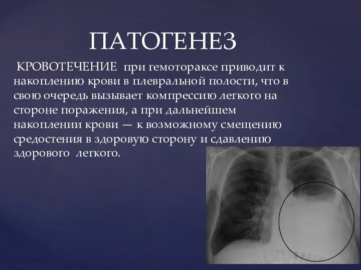 ПАТОГЕНЕЗ КРОВОТЕЧЕНИЕ при гемотораксе приводит к накоплению крови в плевральной полости,