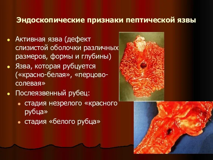 Эндоскопические признаки пептической язвы Активная язва (дефект слизистой оболочки различных размеров,