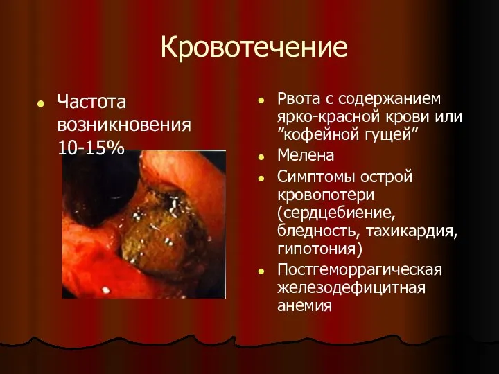 Кровотечение Рвота с содержанием ярко-красной крови или ”кофейной гущей” Мелена Симптомы