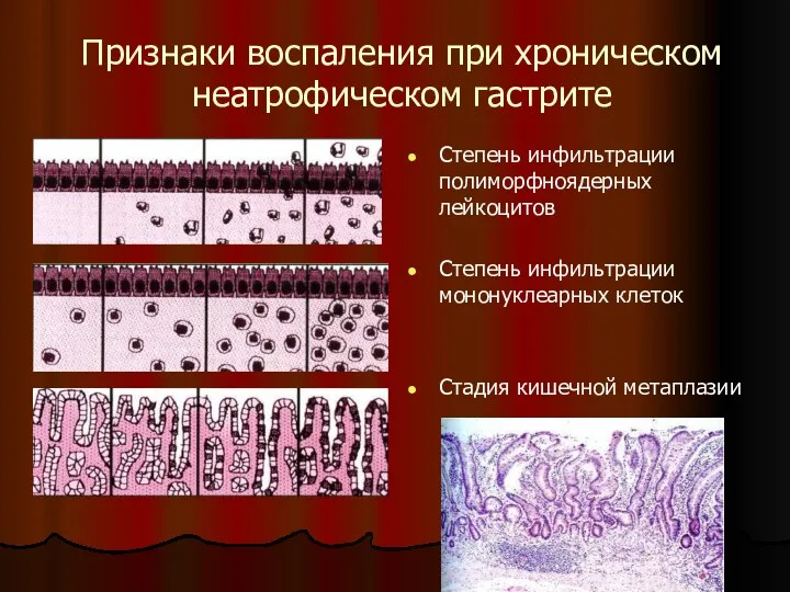 Признаки воспаления при хроническом неатрофическом гастрите Степень инфильтрации полиморфноядерных лейкоцитов Степень