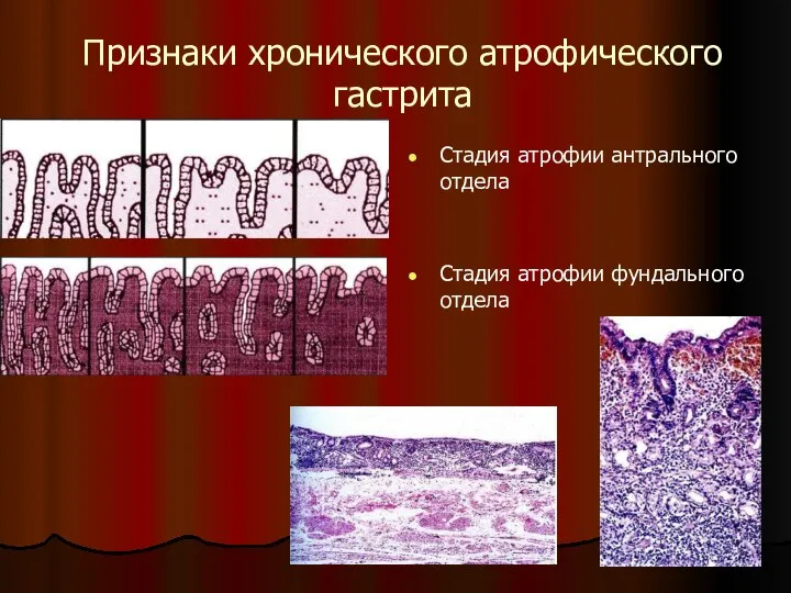 Признаки хронического атрофического гастрита Стадия атрофии антрального отдела Стадия атрофии фундального отдела