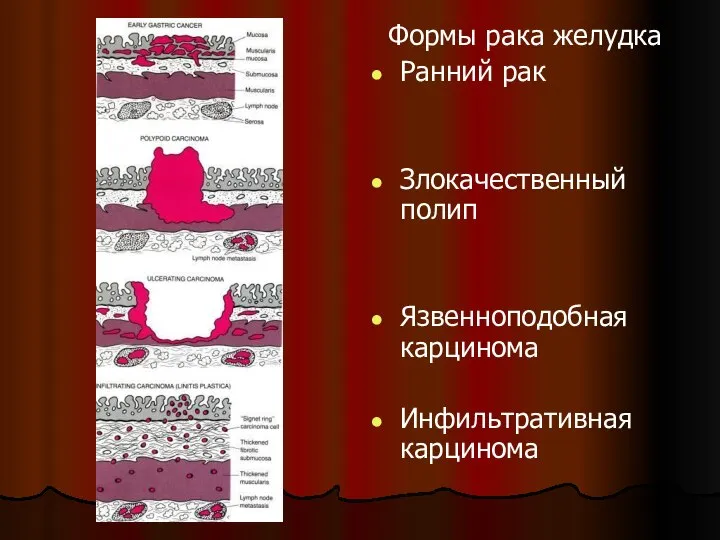 Формы рака желудка Ранний рак Злокачественный полип Язвенноподобная карцинома Инфильтративная карцинома