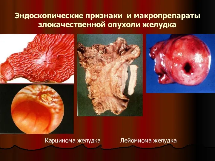 Эндоскопические признаки и макропрепараты злокачественной опухоли желудка Карцинома желудка Лейомиома желудка