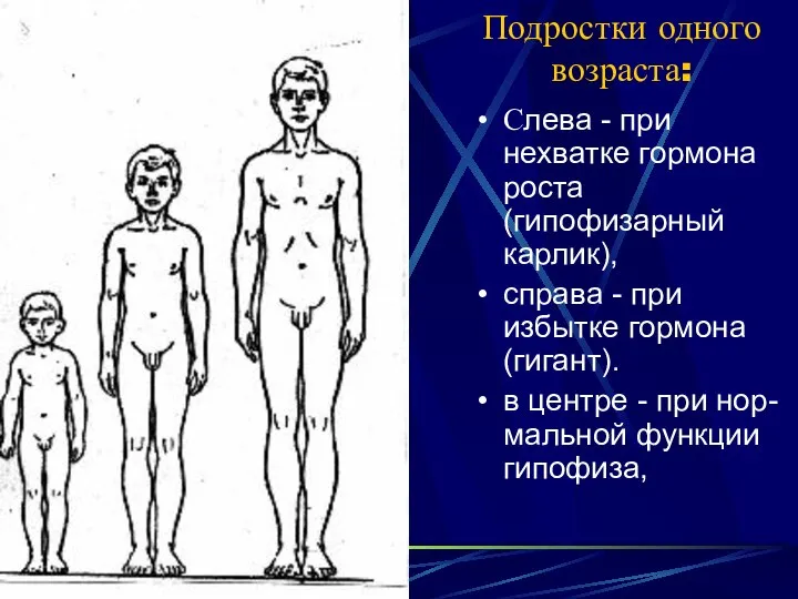 Подростки одного возраста: Слева - при нехватке гормона роста (гипофизарный карлик),