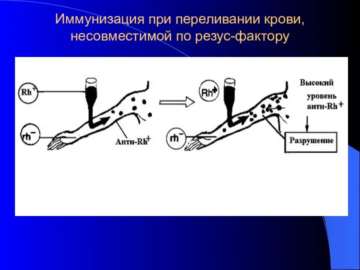 Иммунизация при переливании крови, несовместимой по резус-фактору