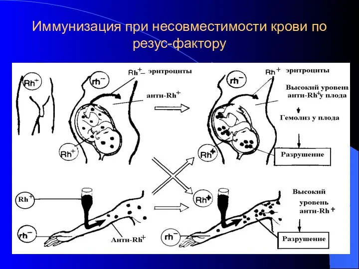 Иммунизация при несовместимости крови по резус-фактору