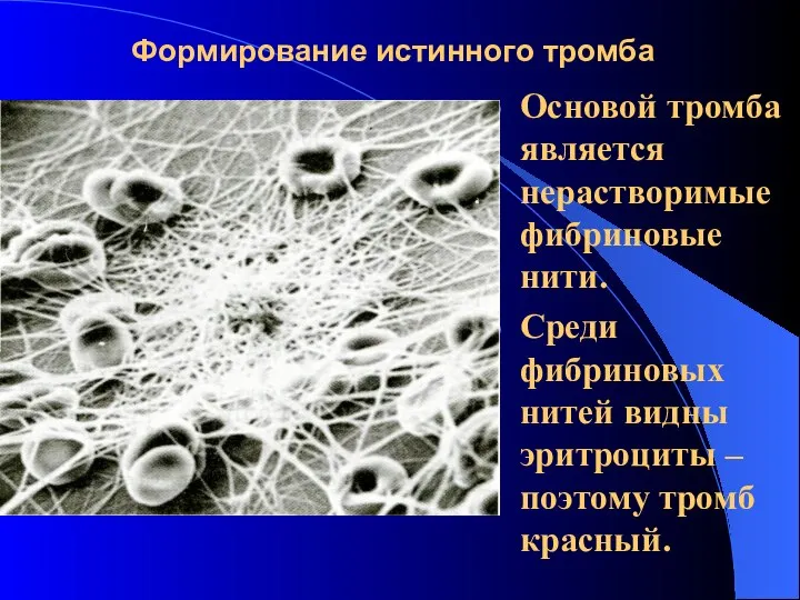 Формирование истинного тромба Основой тромба является нерастворимые фибриновые нити. Среди фибриновых