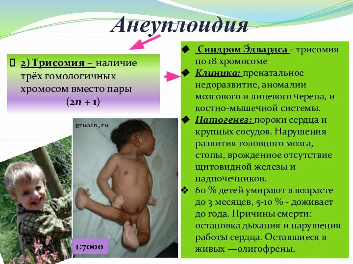 Анеуплоидия 2) Трисомия – наличие трёх гомологичных хромосом вместо пары (2n