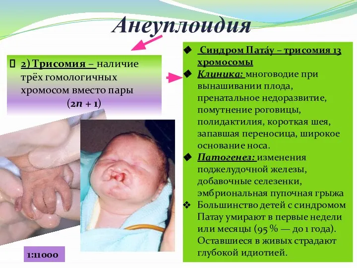 Анеуплоидия 2) Трисомия – наличие трёх гомологичных хромосом вместо пары (2n