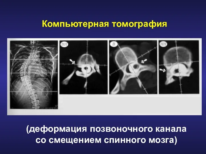 Компьютерная томография (деформация позвоночного канала со смещением спинного мозга)