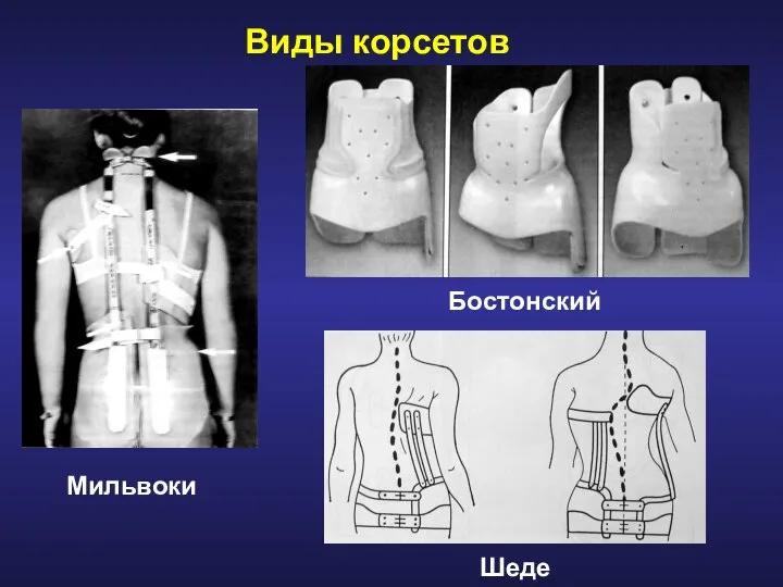 Виды корсетов Мильвоки Бостонский Шеде