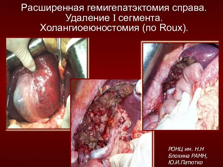 Расширенная гемигепатэктомия справа. Удаление I сегмента. Холангиоеюностомия (по Roux). РОНЦ им. Н.Н Блохина РАМН, Ю.И.Патютко