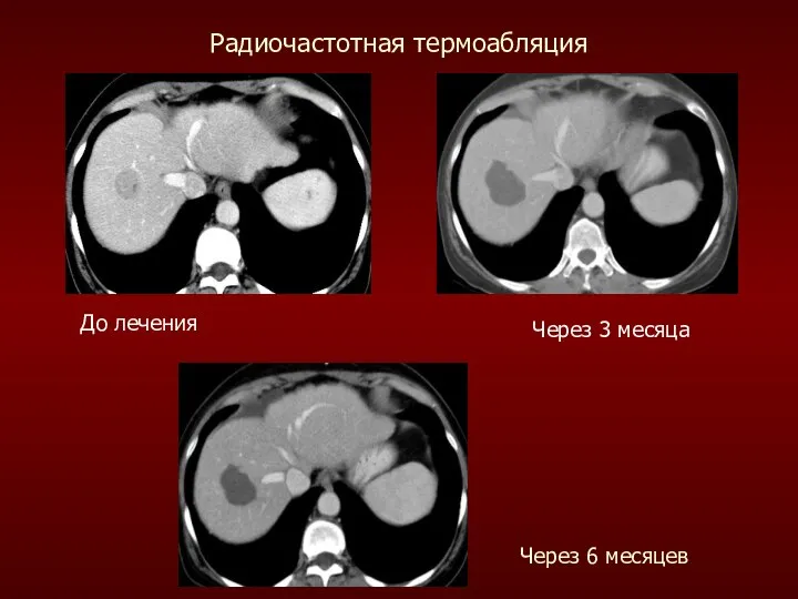 Через 3 месяца Через 6 месяцев До лечения Радиочастотная термоабляция