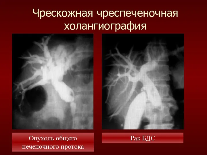 Чрескожная чреспеченочная холангиография Опухоль общего печеночного протока Рак БДС