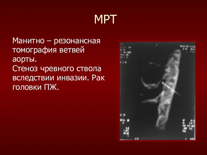 МРТ Манитно – резонансная томография ветвей аорты. Стеноз чревного ствола вследствии инвазии. Рак головки ПЖ.