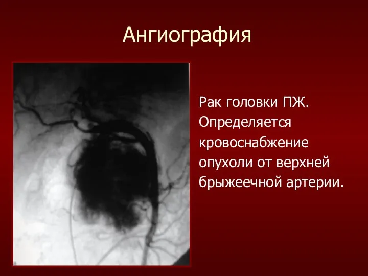 Ангиография Рак головки ПЖ. Определяется кровоснабжение опухоли от верхней брыжеечной артерии.