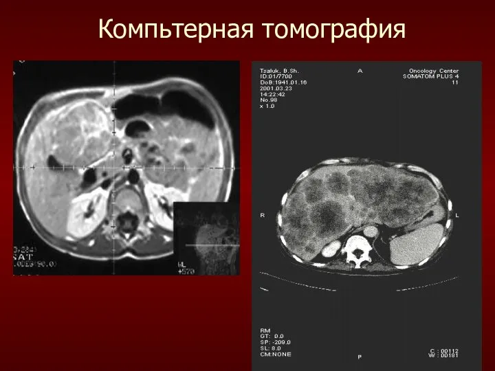 Компьтерная томография