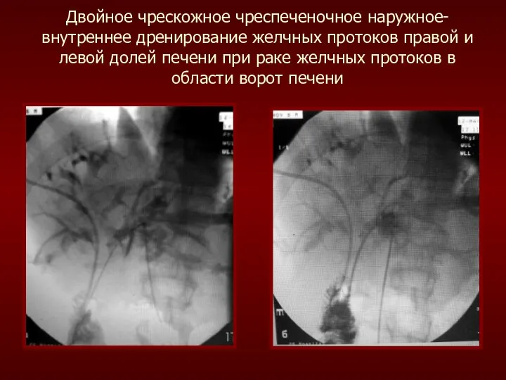 Двойное чрескожное чреспеченочное наружное-внутреннее дренирование желчных протоков правой и левой долей