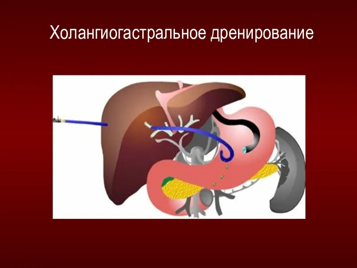 Холангиогастральное дренирование