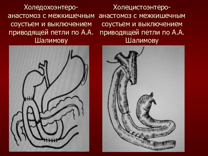 Холедохоэнтеро- анастомоз с межкишечным соустьем и выключением приводящей петли по А.А.Шалимову