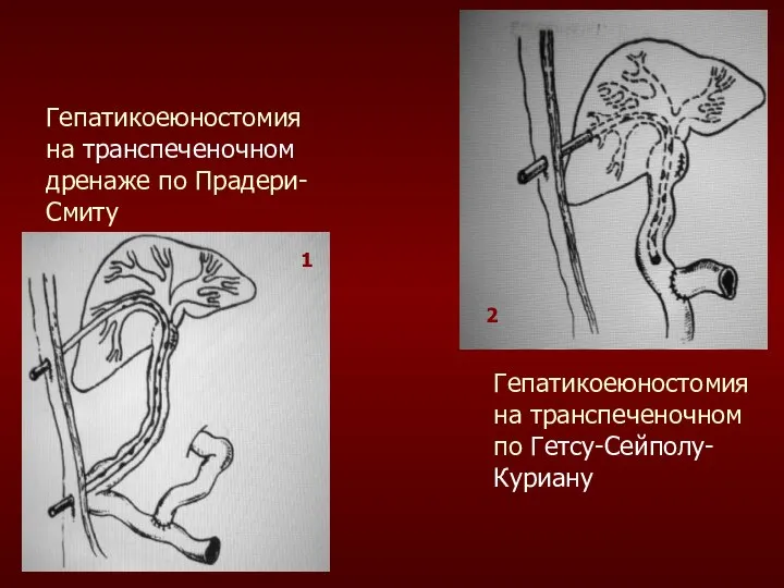 Гепатикоеюностомия на транспеченочном дренаже по Прадери- Смиту Гепатикоеюностомия на транспеченочном по Гетсу-Сейполу-Куриану 2 1