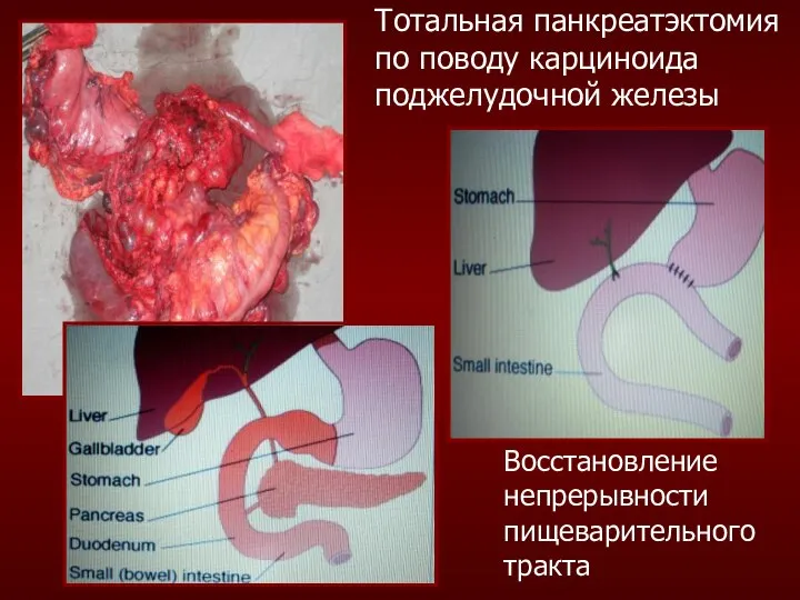 Тотальная панкреатэктомия по поводу карциноида поджелудочной железы Восстановление непрерывности пищеварительного тракта